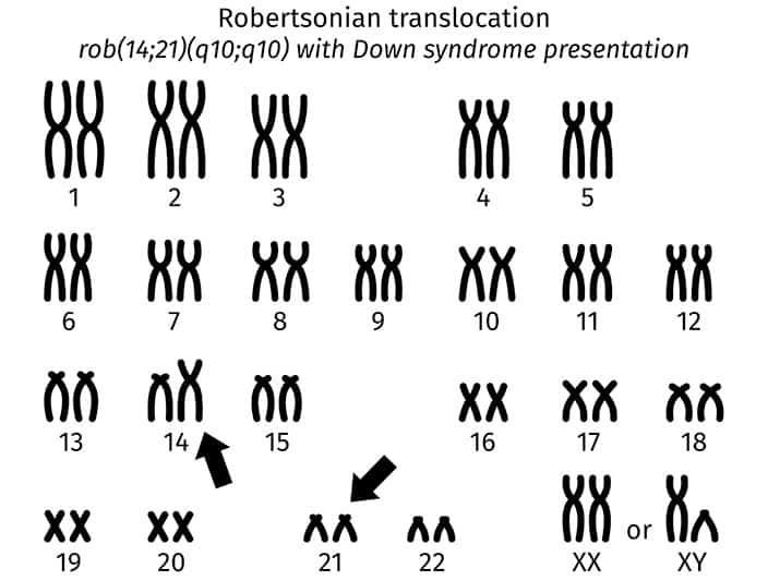 translocation down syndrome