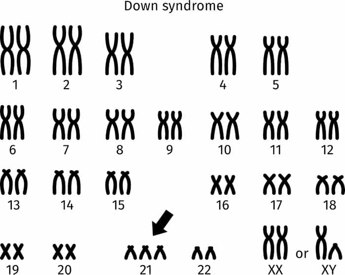 trisomy 21 karyotype